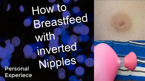 newly inverted nipple|Inverted nipple: Treatment, causes, and pictures